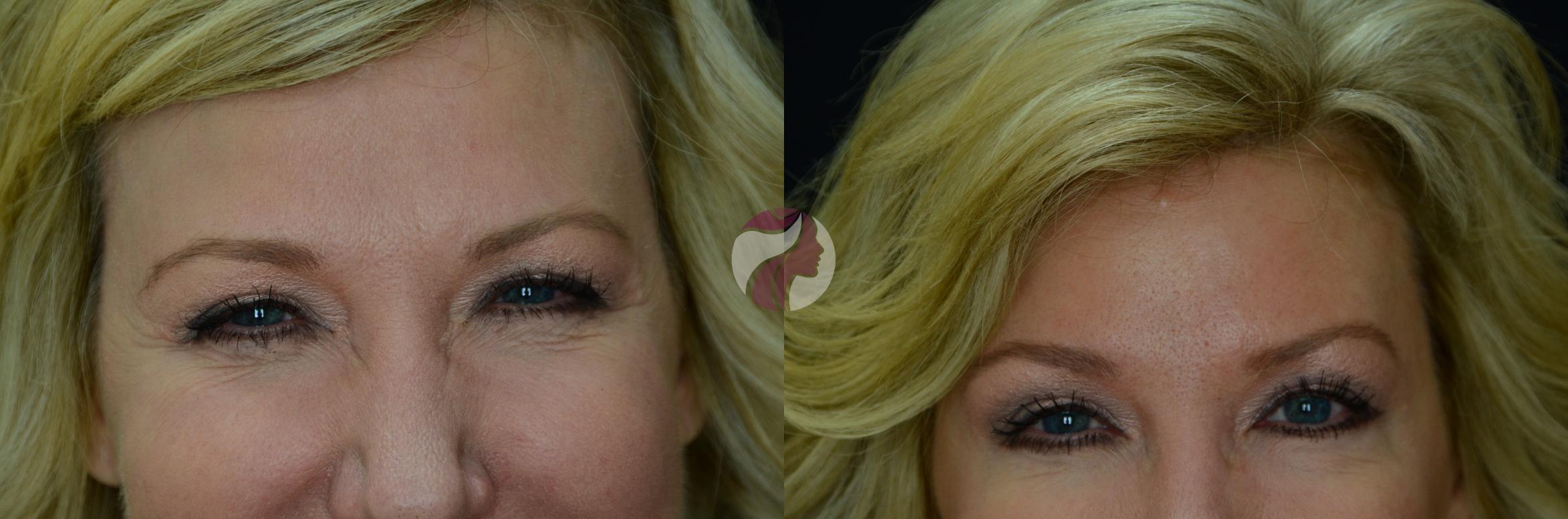 BOTOX® Cosmetic & Dysport® Case 15 Before & After View #1 | Dallas, TX | Dallas Center for Dermatology and Aesthetics