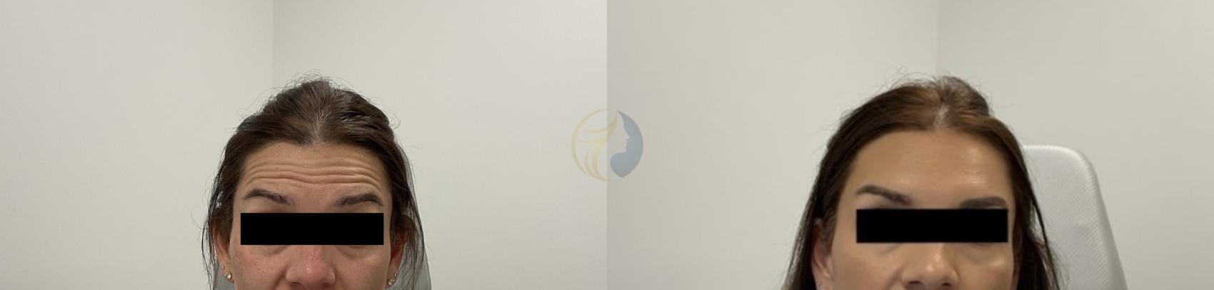 Before & After BOTOX® Cosmetic, Dysport®, & Daxxify® Case 110 Front View in Plano, Frisco, Dallas, Texas