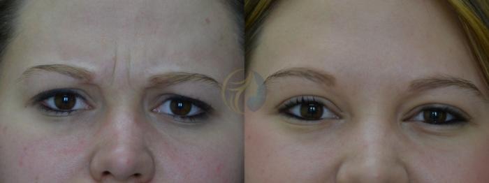 Before & After BOTOX® Cosmetic, Dysport®, & Daxxify® Case 39 View #1 View in Plano, Frisco, Dallas, Texas