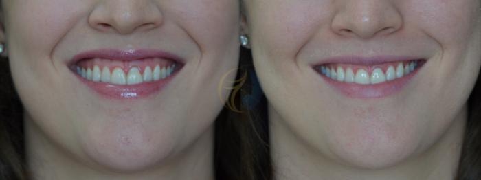 Before & After BOTOX® Cosmetic, Dysport®, & Daxxify® Case 44 View #1 View in Plano, Frisco, Dallas, Texas