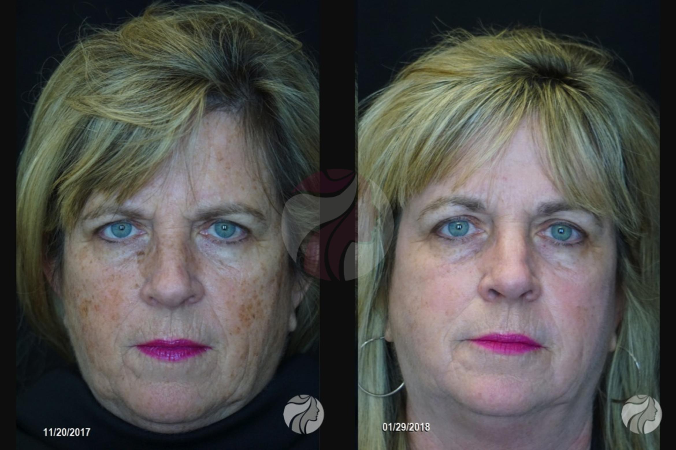 Chemical Peels Case 83 Before & After View #1 | Dallas, Plano, and Frisco, TX | Dallas Center for Dermatology and Aesthetics