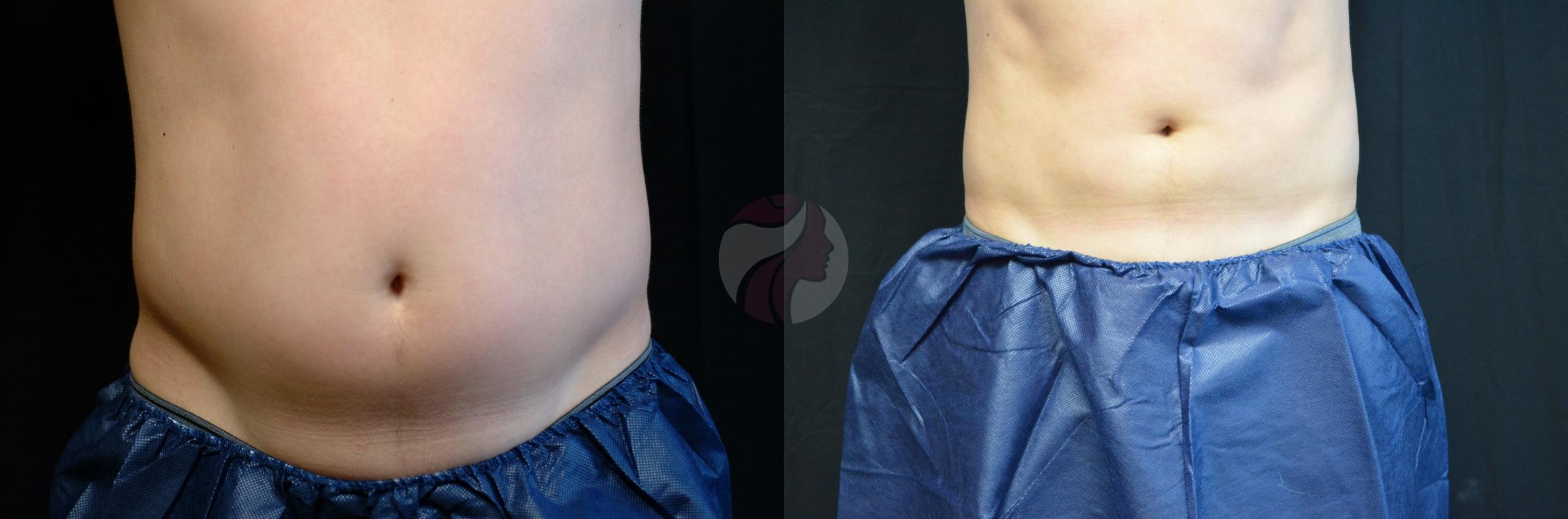 CoolSculpting® Case 14 Before & After View #1 | Dallas, TX | Dallas Center for Dermatology and Aesthetics