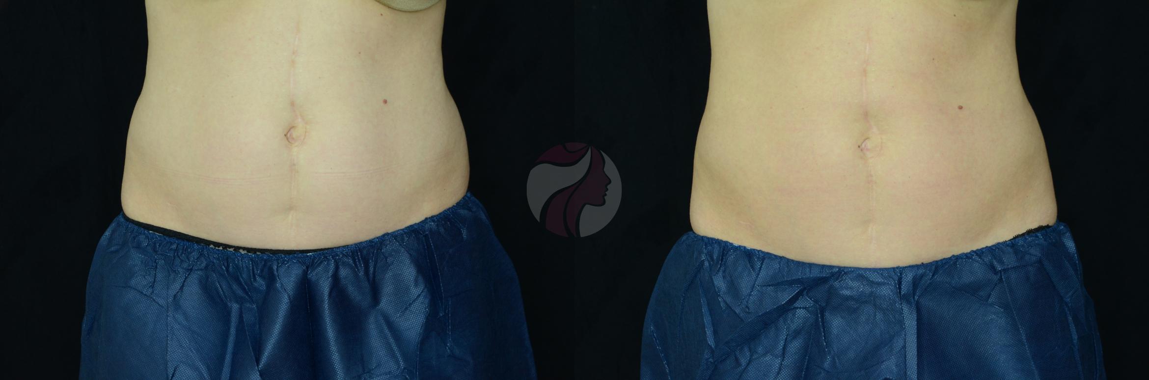 CoolSculpting® Case 25 Before & After View #1 | Dallas, TX | Dallas Center for Dermatology and Aesthetics