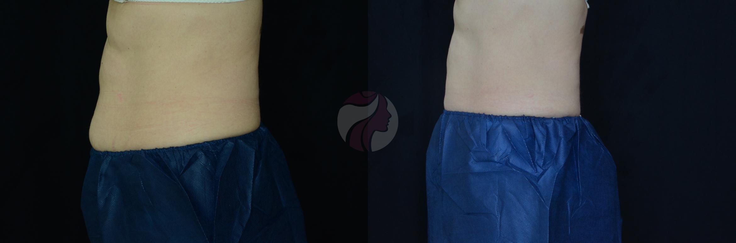 CoolSculpting® Case 40 Before & After View #1 | Dallas, TX | Dallas Center for Dermatology and Aesthetics