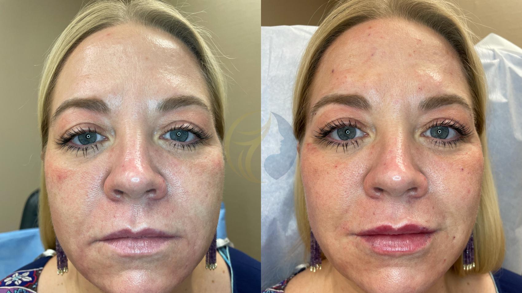 Before & After Dermal Fillers Case 111 Front View in Plano, Frisco, Dallas, Texas