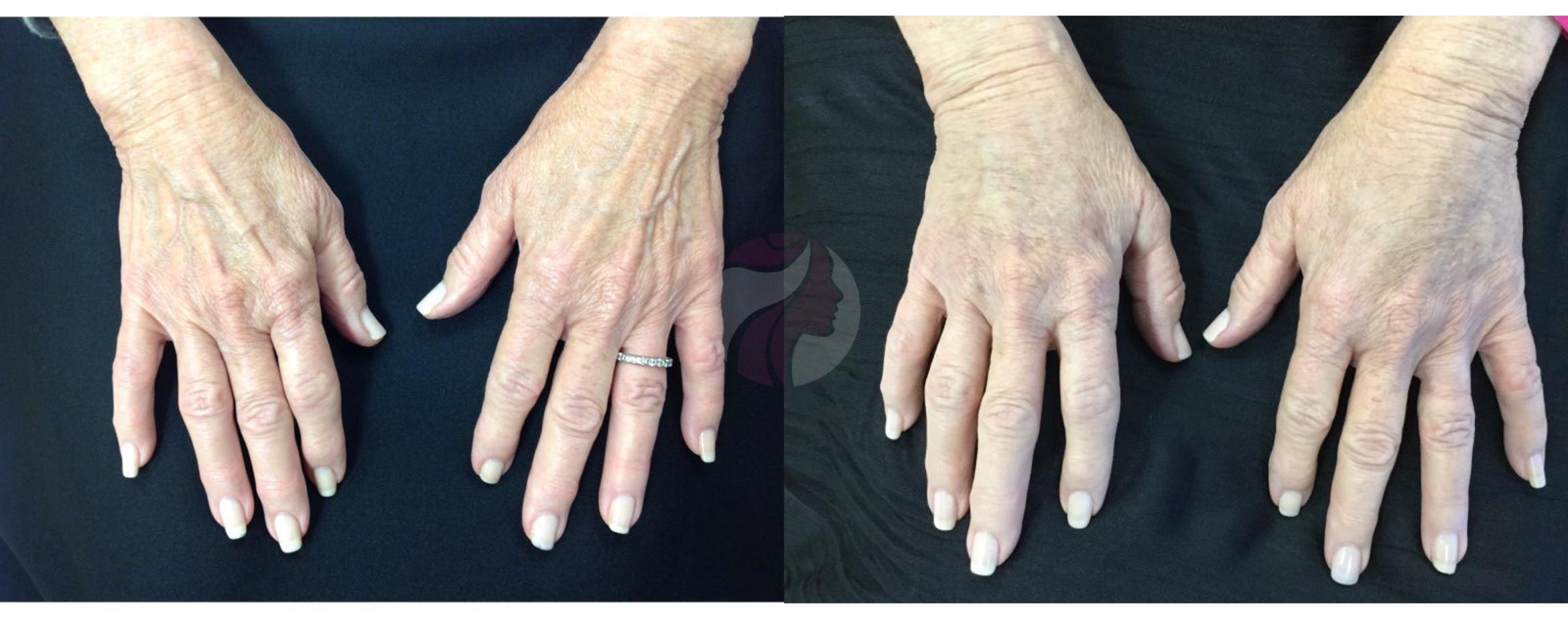 Dermal Fillers Case 76 Before & After View #1 | Dallas, TX | Dallas Center for Dermatology and Aesthetics