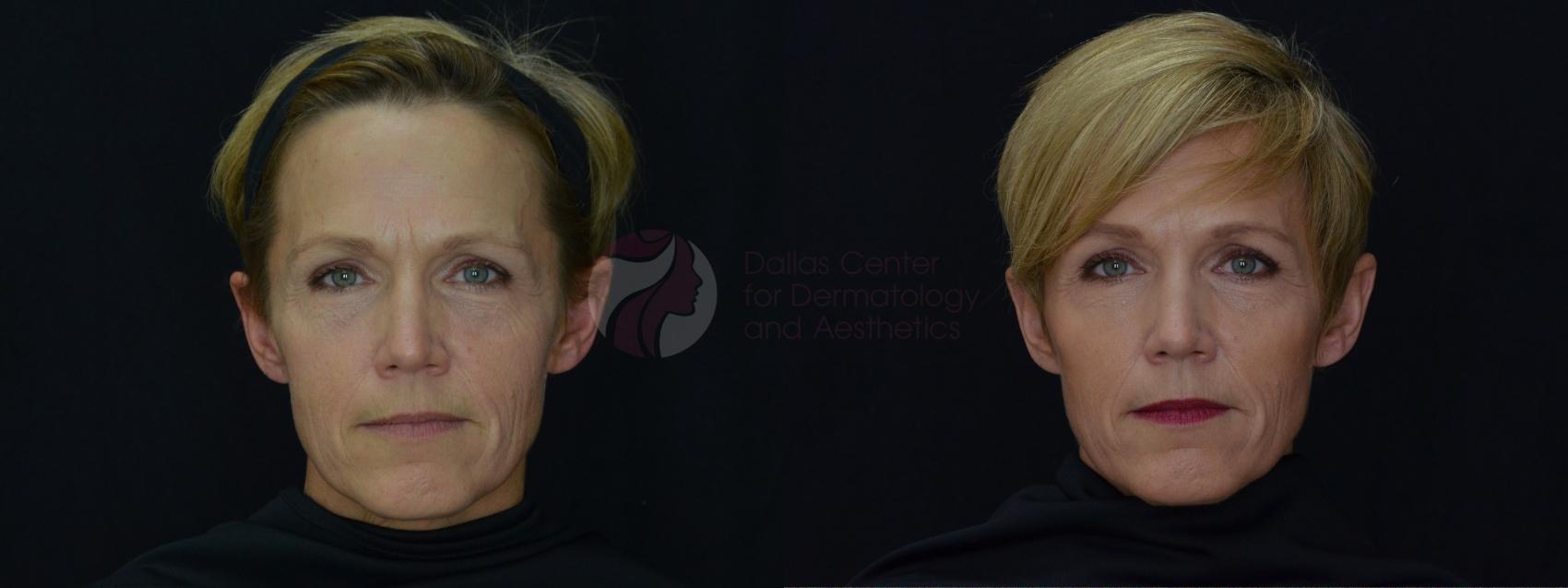 Before & After JUVÉDERM VOLUMA XC Case 47 Front View in Dallas, TX