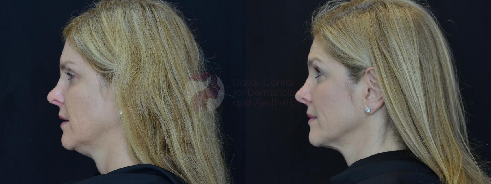 Before & After Kybella™ Case 70 Left Side View in Dallas, TX