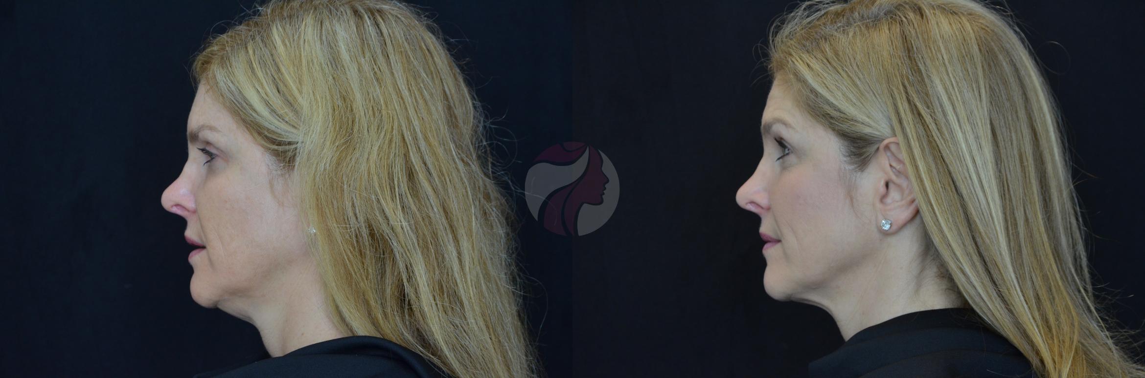 Kybella™ Case 70 Before & After View #1 | Dallas, TX | Dallas Center for Dermatology and Aesthetics