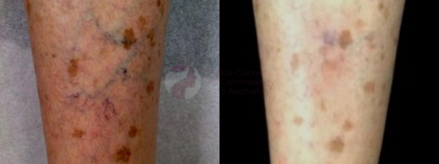 Before & After Sclerotherapy for Veins Case 61 Front View in Dallas, TX