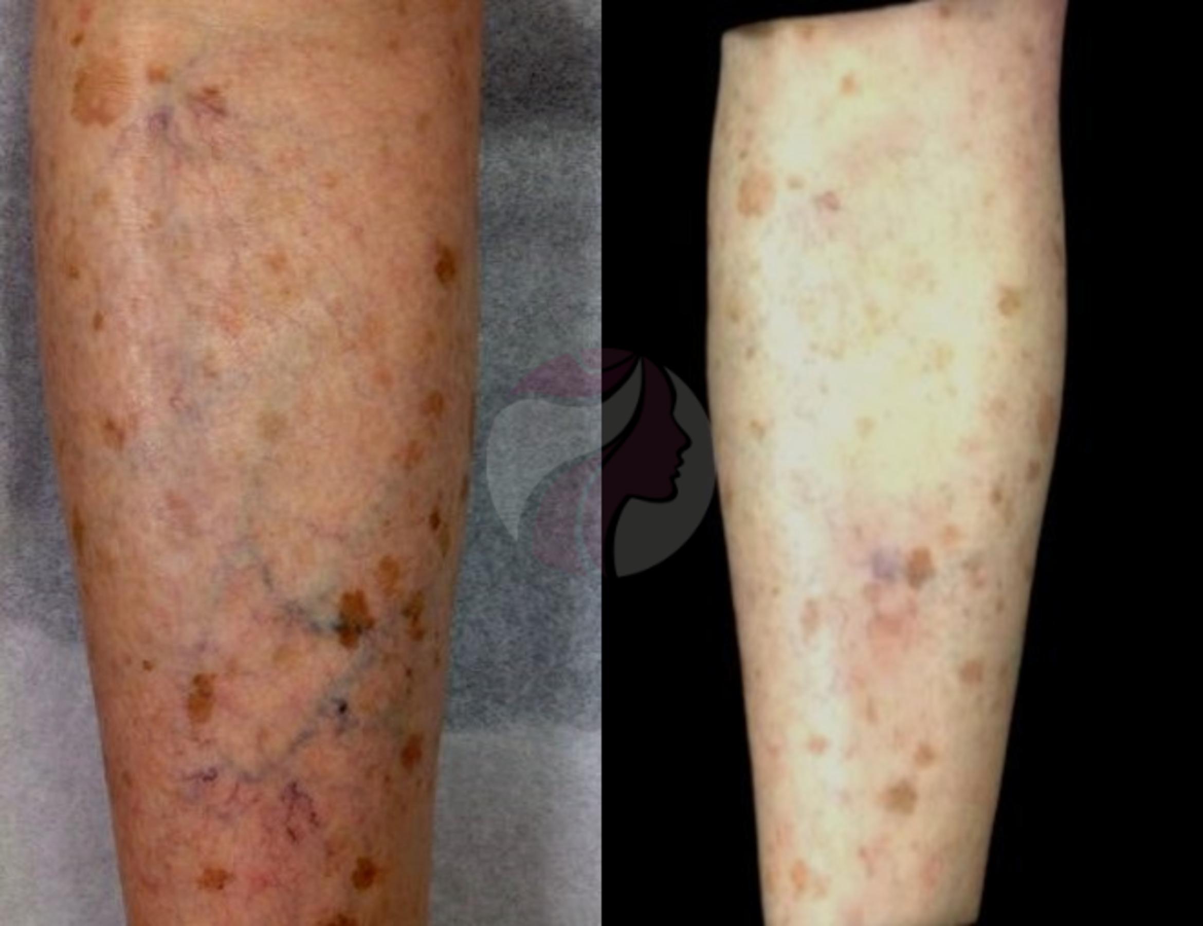 Sclerotherapy for Veins Case 61 Before & After View #1 | Dallas, Plano, and Frisco, TX | Dallas Center for Dermatology and Aesthetics