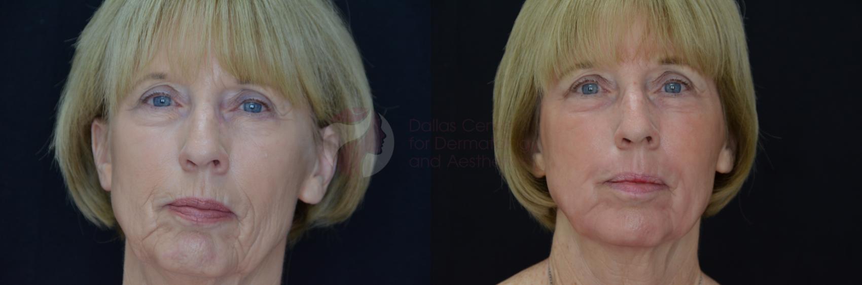 Before & After Skin Resurfacing Case 43 View #1 View in Dallas, TX