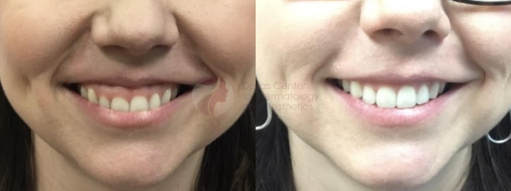 Before & After BOTOX® Cosmetic & Dysport® Case 101 View #1 View in Dallas, Plano, and Frisco, TX