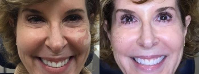 Before & After BOTOX® Cosmetic & Dysport® Case 107 Front View in Dallas, TX