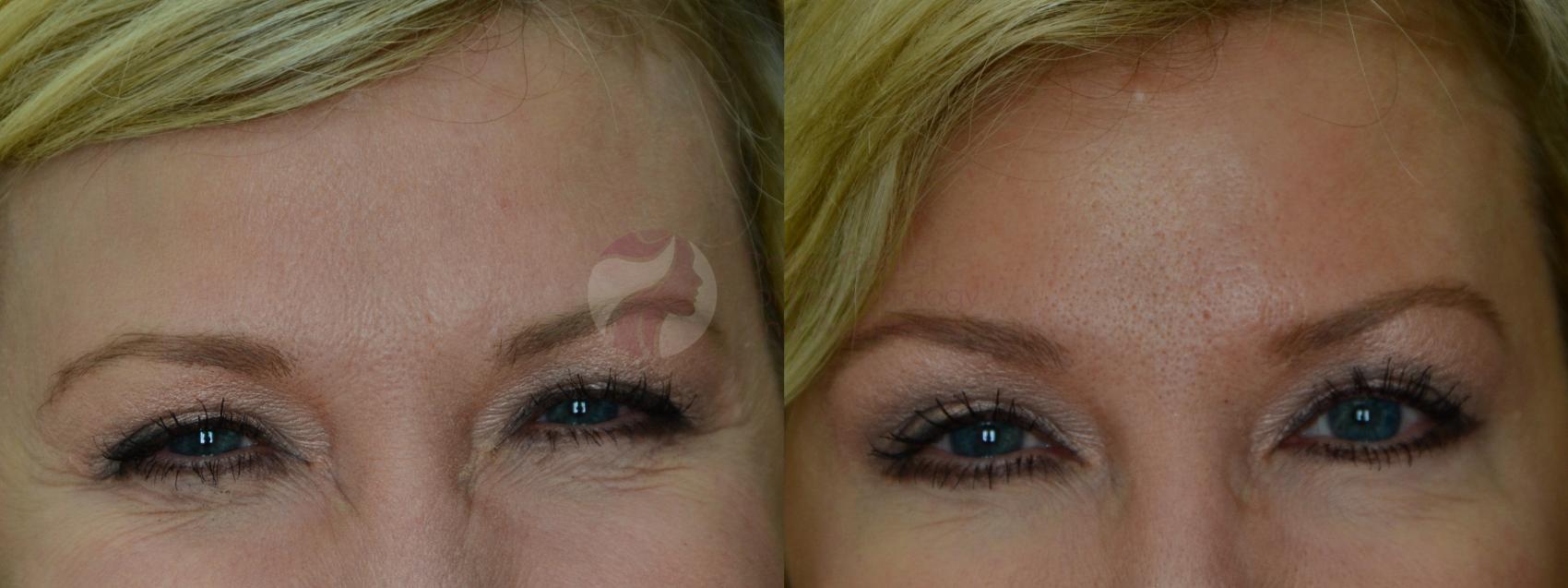 Before & After BOTOX® Cosmetic & Dysport® Case 15 Front View in Dallas, Plano, and Frisco, TX