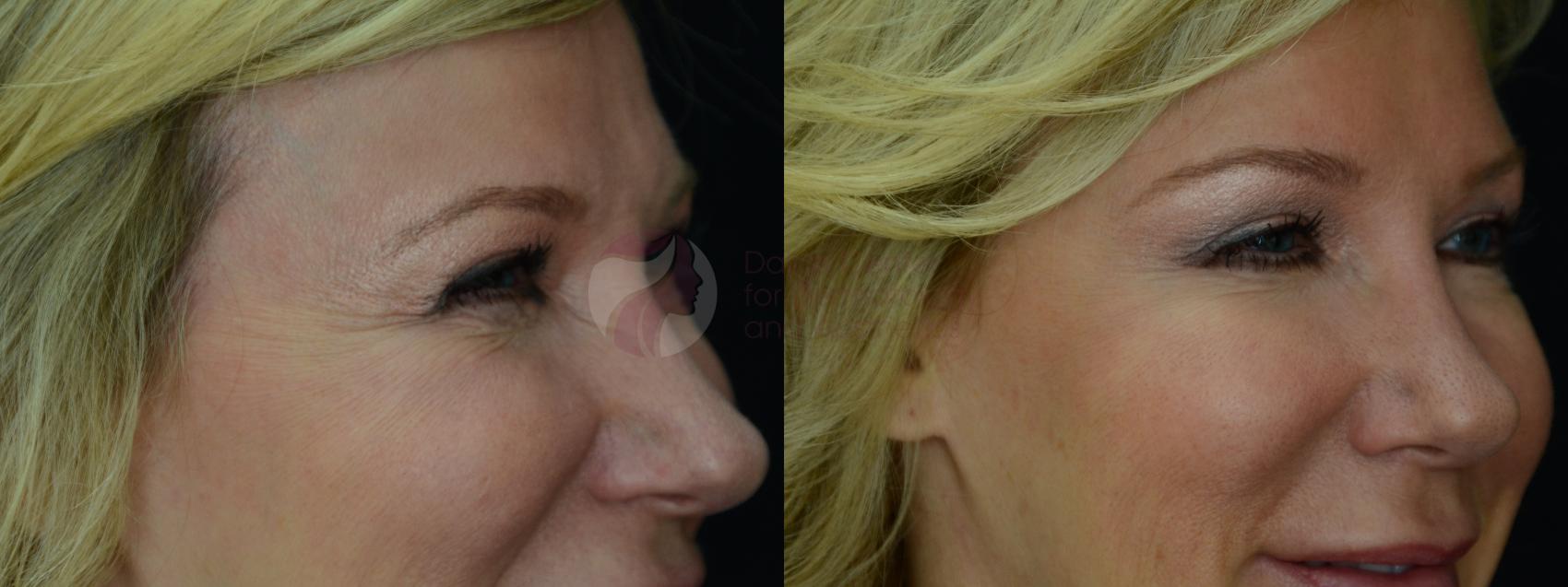 Before & After BOTOX® Cosmetic & Dysport® Case 15 View #2 View in Dallas, TX
