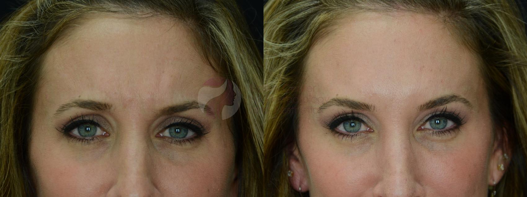 Before & After BOTOX® Cosmetic & Dysport® Case 19 View #1 View in Dallas, Plano, and Frisco, TX