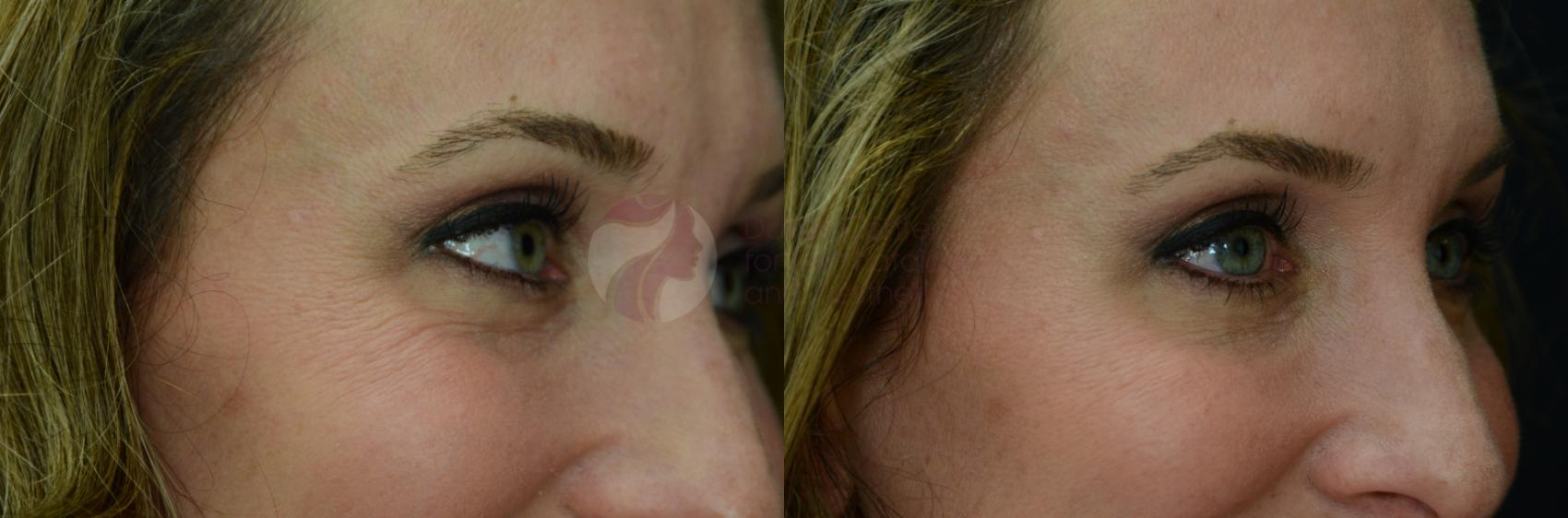 Before & After BOTOX® Cosmetic & Dysport® Case 19 View #2 View in Dallas, Plano, and Frisco, TX