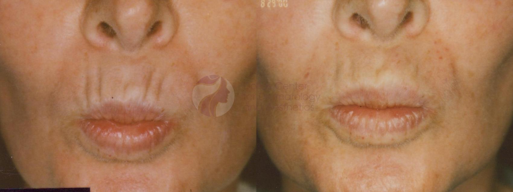 Before & After BOTOX® Cosmetic, Dysport®, & Daxxify® Case 31 View #1 View in Plano, Frisco, Dallas, Texas