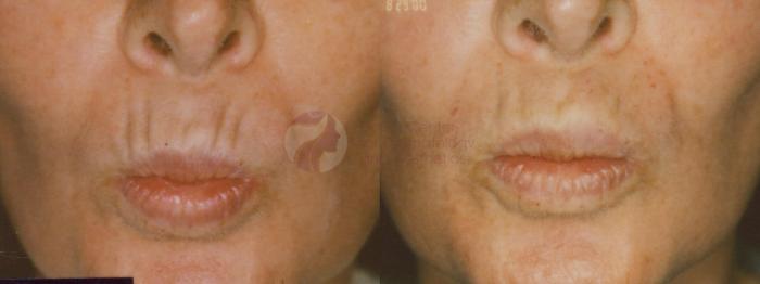 Before & After BOTOX® Cosmetic & Dysport® Case 31 View #1 View in Dallas, TX
