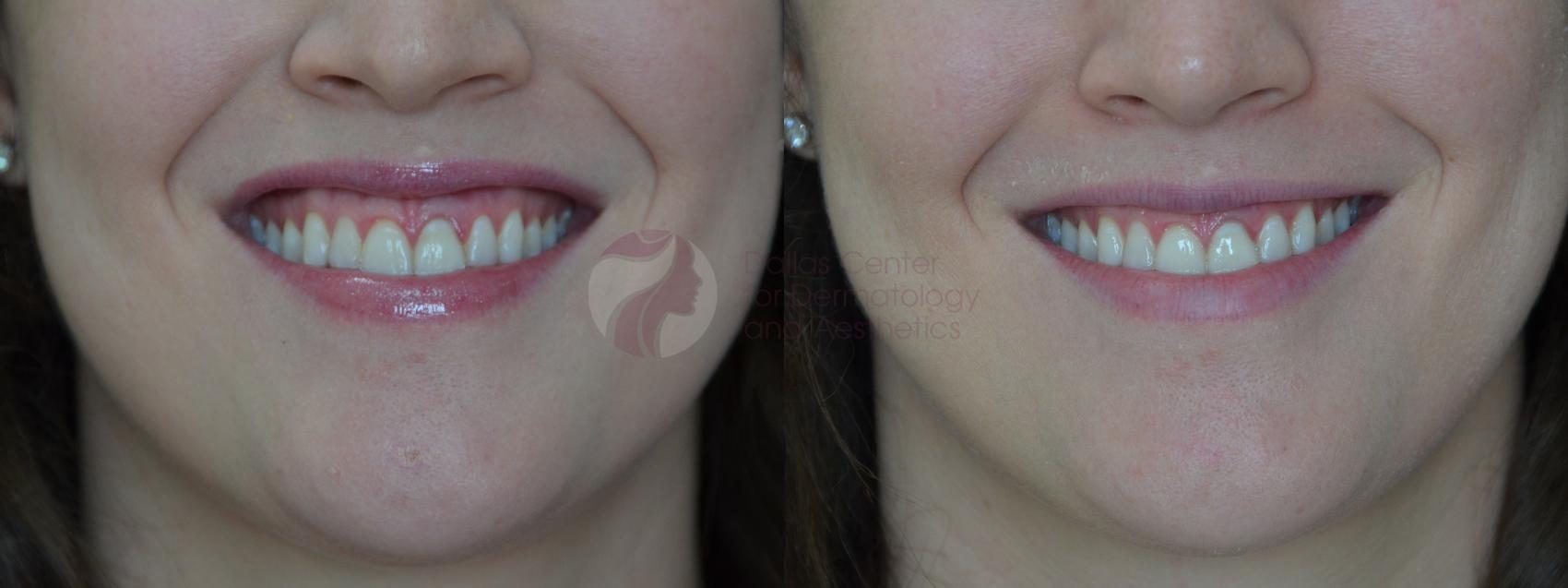 Before & After BOTOX® Cosmetic, Dysport®, & Daxxify® Case 44 View #1 View in Plano, Frisco, Dallas, Texas