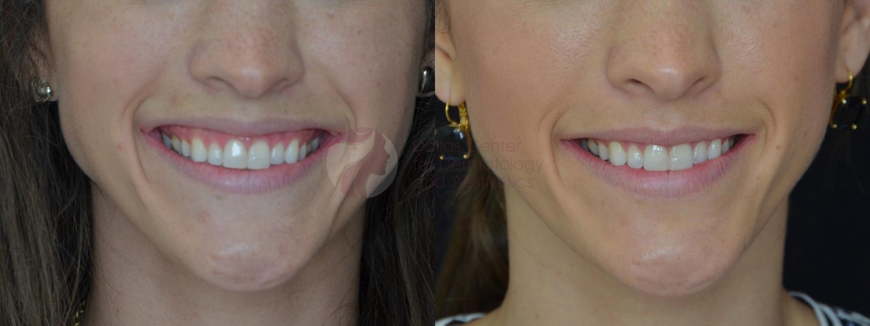 Before & After BOTOX® Cosmetic, Dysport®, & Daxxify® Case 55 View #1 View in Plano, Frisco, Dallas, Texas