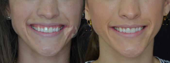 Before & After BOTOX® Cosmetic & Dysport® Case 55 View #1 View in Dallas, TX
