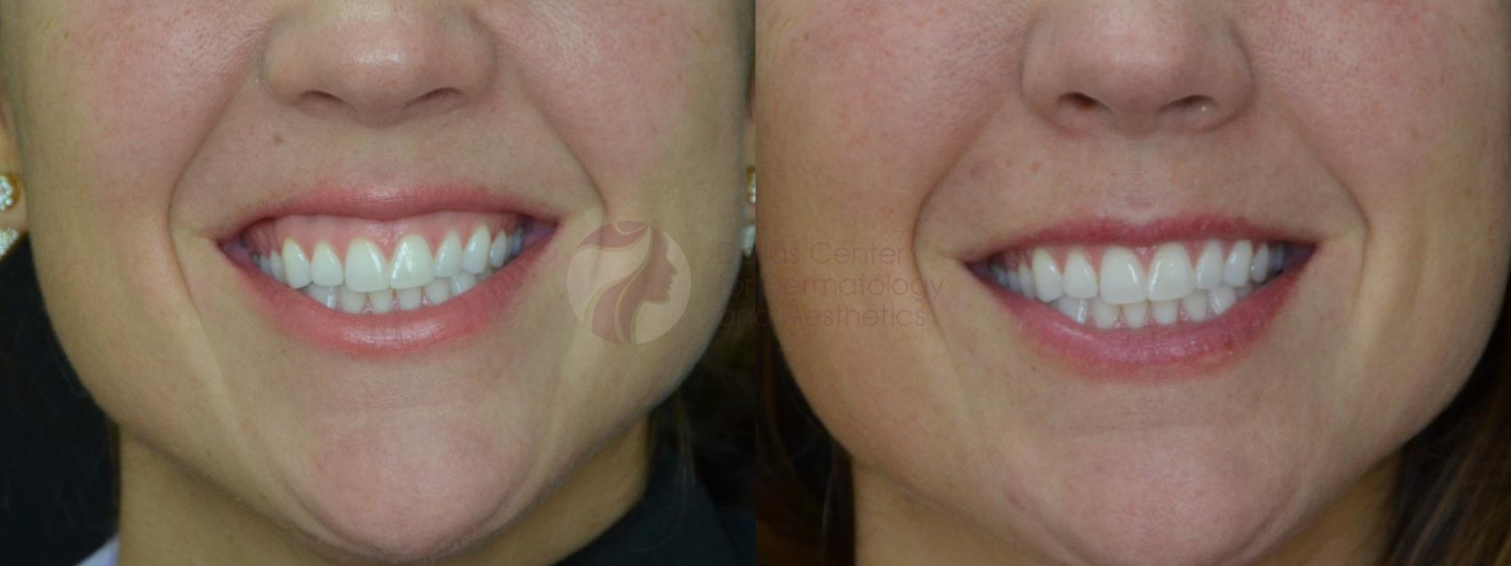 Before & After BOTOX® Cosmetic, Dysport®, & Daxxify® Case 58 View #1 View in Plano, Frisco, Dallas, Texas