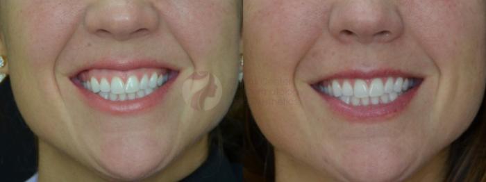 Before & After BOTOX® Cosmetic & Dysport® Case 58 View #1 View in Dallas, TX