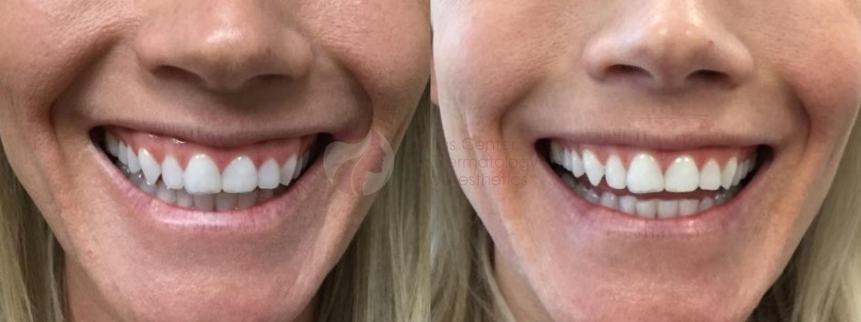Before & After BOTOX® Cosmetic & Dysport® Case 89 View #1 View in Dallas, Plano, and Frisco, TX