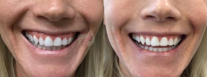 Before & After BOTOX® Cosmetic & Dysport® Case 89 View #1 View in Dallas, TX