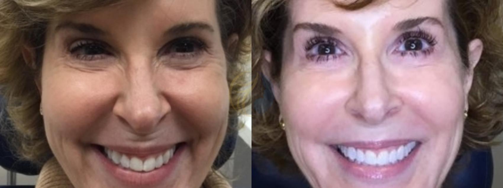 Before & After BOTOX® Cosmetic, Dysport®, & Daxxify® Case 107 Front View in Plano, Frisco, Dallas, Texas