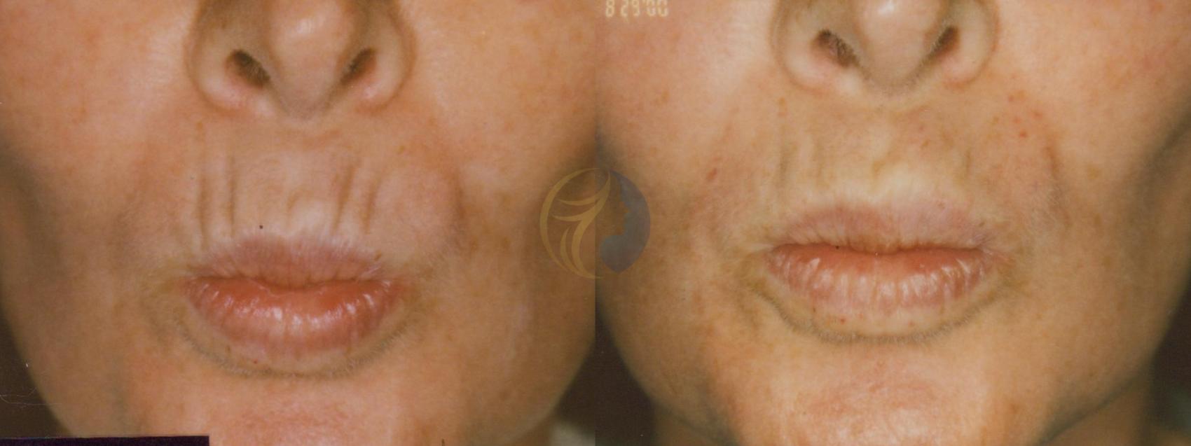 Before & After BOTOX® Cosmetic, Dysport®, & Daxxify® Case 31 View #1 View in Plano, Frisco, Dallas, Texas