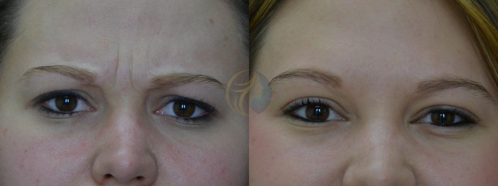 Before & After BOTOX® Cosmetic, Dysport®, & Daxxify® Case 39 View #1 View in Plano, Frisco, Dallas, Texas