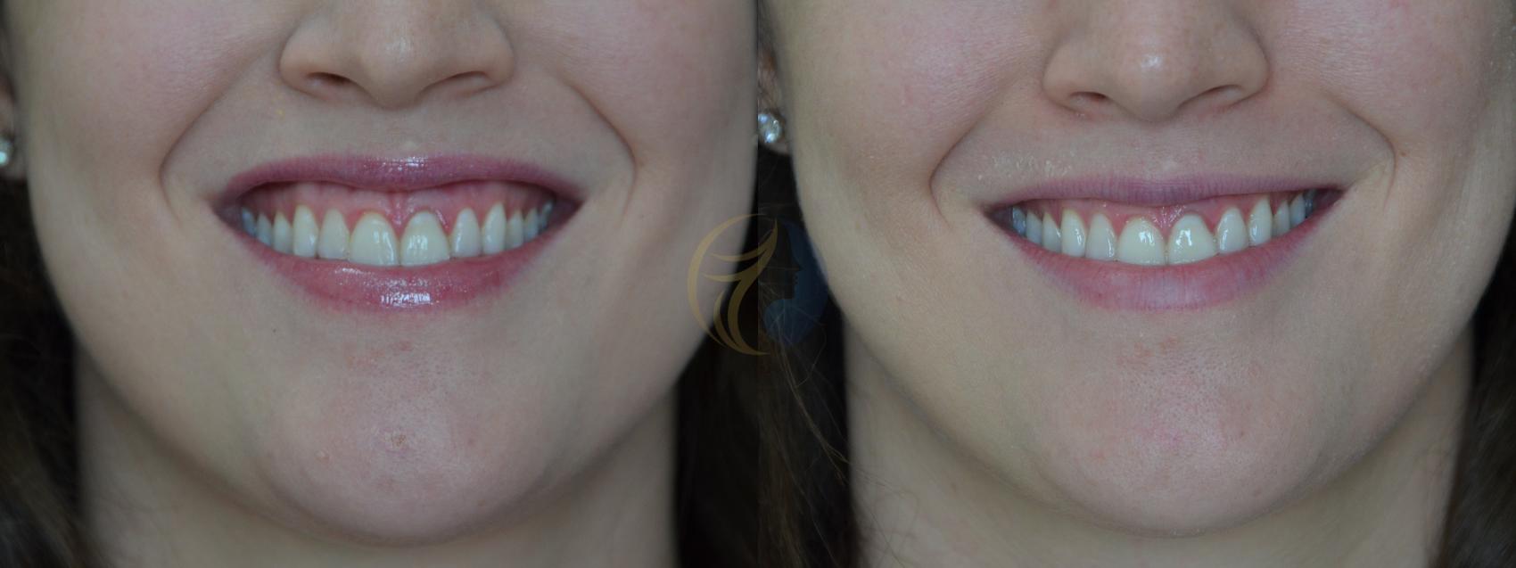Before & After BOTOX® Cosmetic, Dysport®, & Daxxify® Case 44 View #1 View in Plano, Frisco, Dallas, Texas