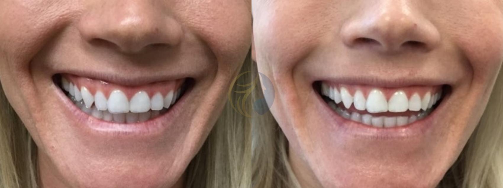 Before & After BOTOX® Cosmetic, Dysport®, & Daxxify® Case 89 View #1 View in Plano, Frisco, Dallas, Texas