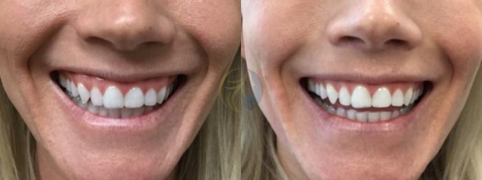 Before & After BOTOX® Cosmetic, Dysport®, & Daxxify® Case 89 View #1 View in Plano, Frisco, Dallas, Texas