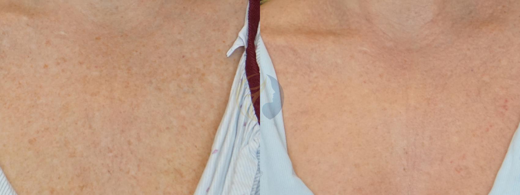 Chemical Peels Before and After Pictures Case 108 Plano, Frisco, Dallas, Texas Dallas Center