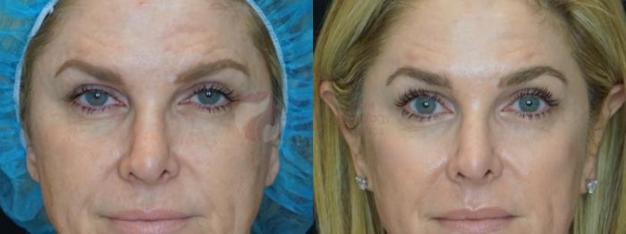 Before & After Chemical Peels Case 108 Front View in Dallas, TX