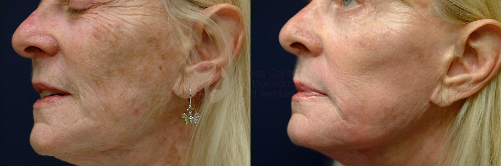 Before & After Chemical Peels Case 26 View #1 View in Dallas, Plano, and Frisco, TX