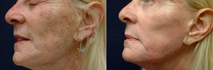 Before & After Chemical Peels Case 26 View #1 View in Dallas, TX