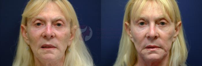 Before & After Chemical Peels Case 26 View #2 View in Dallas, TX