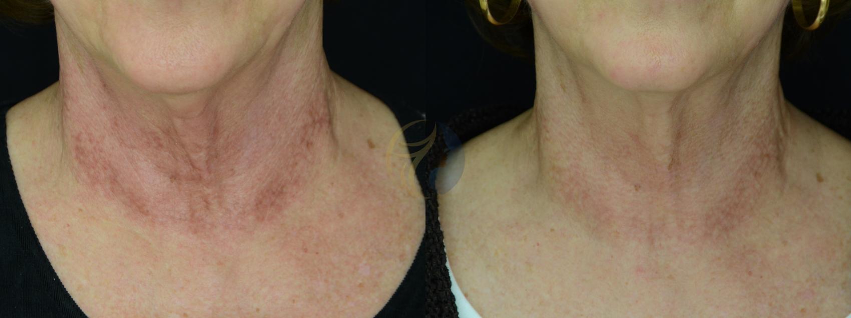 Chemical Peels Before and After Pictures Case 28 Dallas, TX Dallas Center for Dermatology