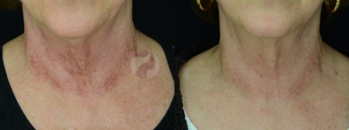 Before & After Chemical Peels Case 28 Front Neck and Chest View in Dallas, TX