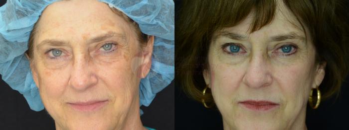 Before & After Chemical Peels Case 28 Front View in Dallas, TX