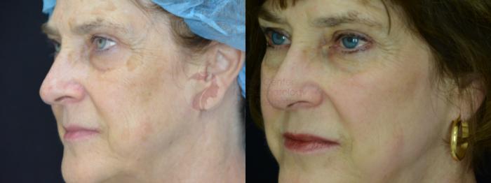 Before & After Chemical Peels Case 28 Left Oblique View in Dallas, TX