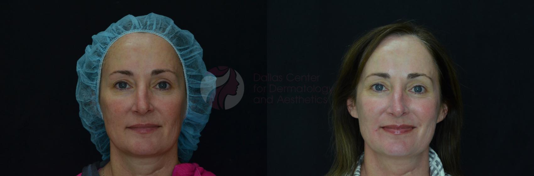 Before & After Chemical Peels Case 62 View #1 View in Dallas, Plano, and Frisco, TX