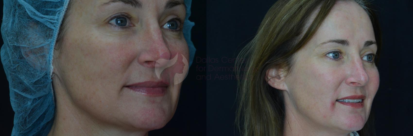 Before & After Chemical Peels Case 62 View #2 View in Dallas, Plano, and Frisco, TX