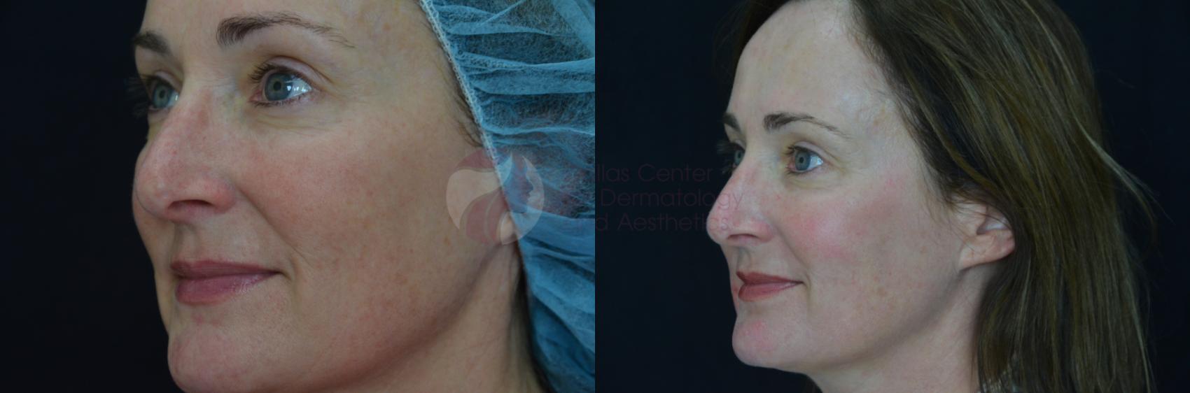 Before & After Chemical Peels Case 62 View #3 View in Dallas, Plano, and Frisco, TX