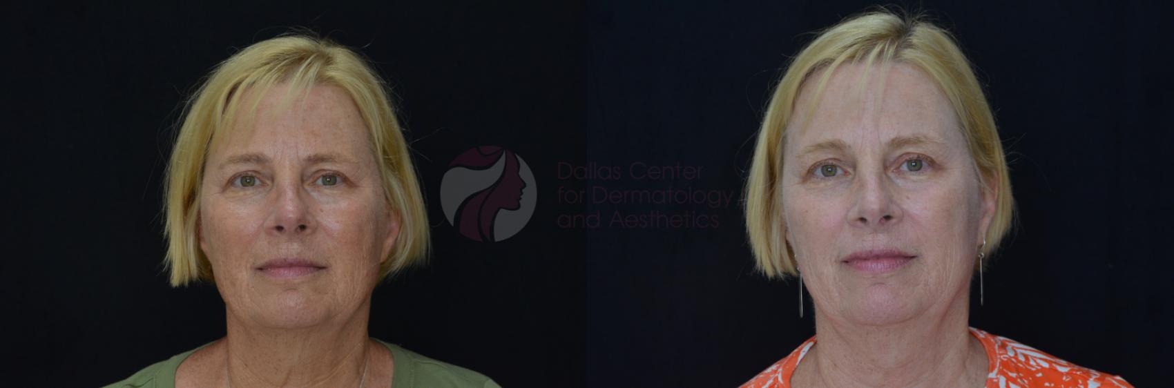 Before & After Chemical Peels Case 63 View #1 View in Dallas, Plano, and Frisco, TX